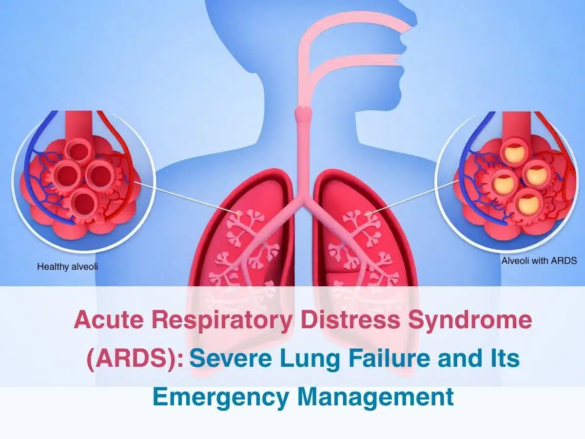 Acute Respiratory Distress Syndrome ARDS_ Severe Lung Failure and Its Emergency Management 1 - Multispeciality Hospital Acute Respiratory Distress Syndrome ARDS_ Severe Lung Failure and Its Emergency Management