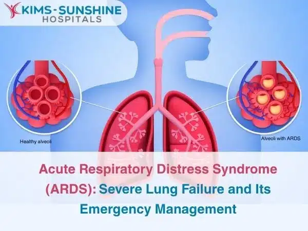 Acute Respiratory Distress Syndrome ARDS_ Severe Lung Failure and Its Emergency Management