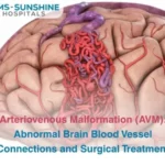 Arteriovenous Malformation AVM_ Abnormal Brain Blood Vessel Connections and Surgical Treatment