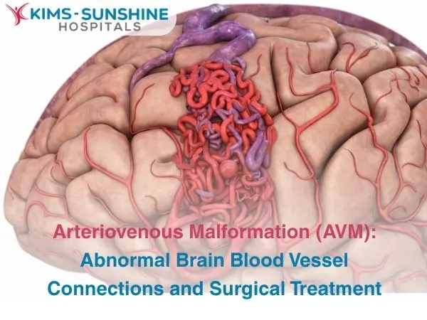 Arteriovenous Malformation AVM_ Abnormal Brain Blood Vessel Connections and Surgical Treatment