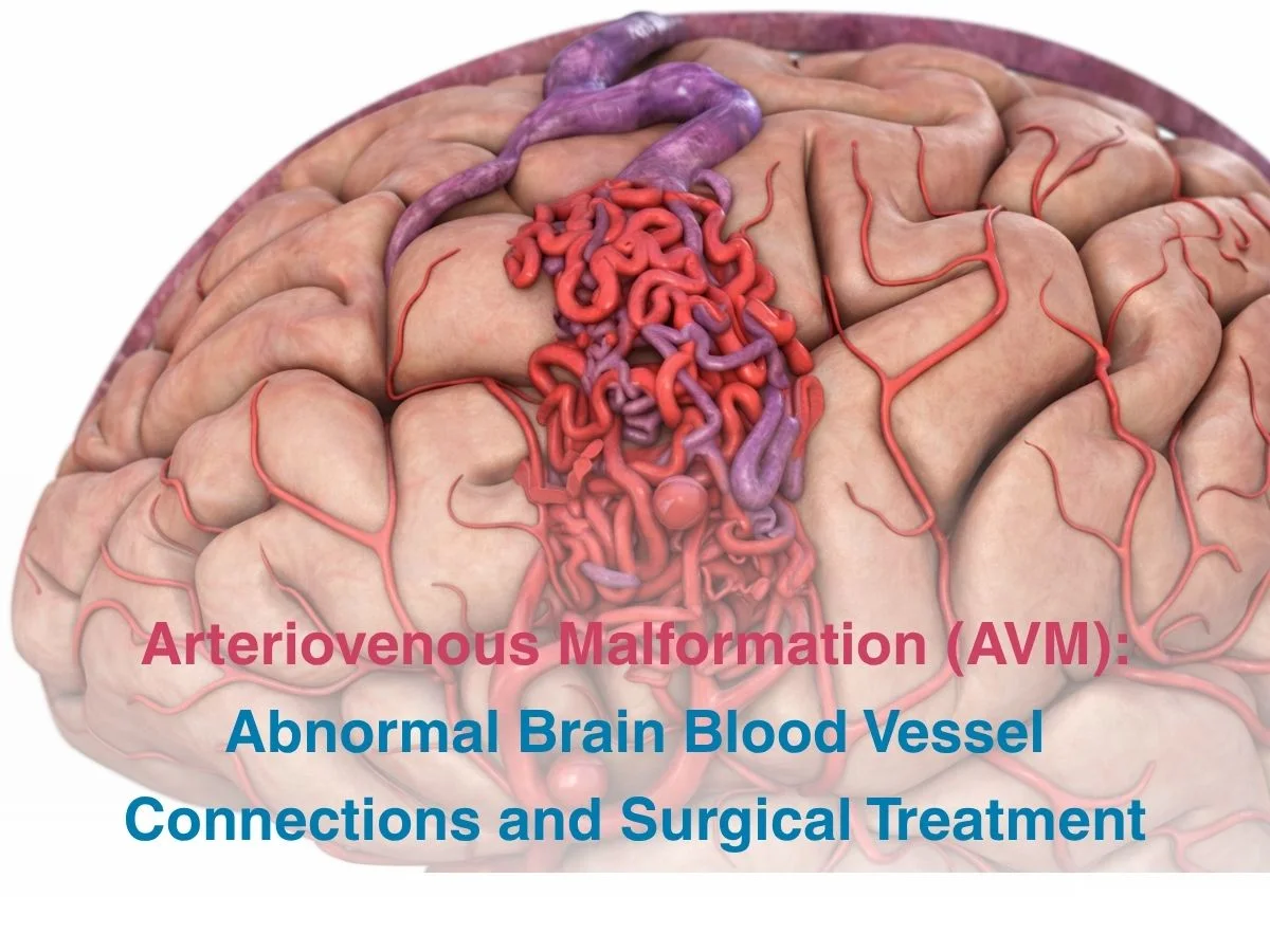 Arteriovenous Malformation AVM_ Abnormal Brain Blood Vessel Connections and Surgical Treatment