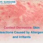 Contact Dermatitis_ Skin Reactions Caused by Allergens and Irritants