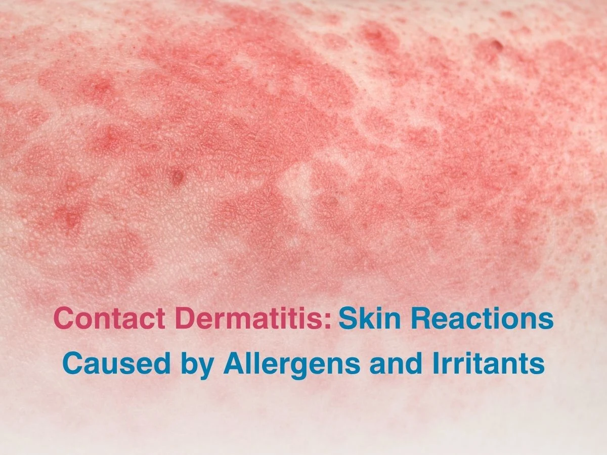 Contact Dermatitis_ Skin Reactions Caused by Allergens and Irritants - Multispeciality Hospital Contact Dermatitis_ Skin Reactions Caused by Allergens and Irritants