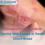 Hidradenitis Suppurativa_ Painful Skin Lumps in Sweat Gland Areas