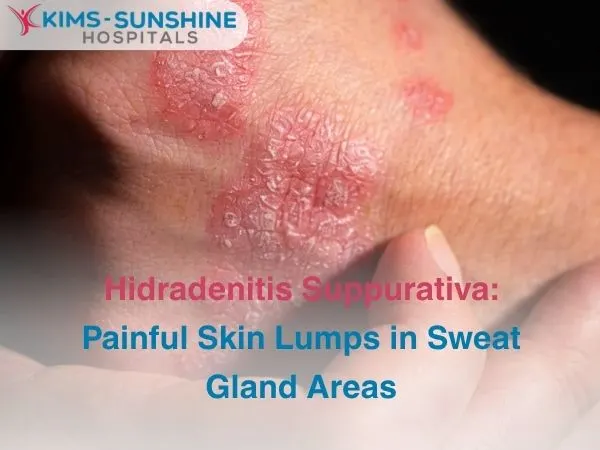 Hidradenitis Suppurativa_ Painful Skin Lumps in Sweat Gland Areas