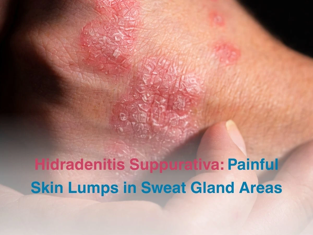 Hidradenitis Suppurativa_ Painful Skin Lumps in Sweat Gland Areas - Multispeciality Hospital Hidradenitis Suppurativa_ Painful Skin Lumps in Sweat Gland Areas