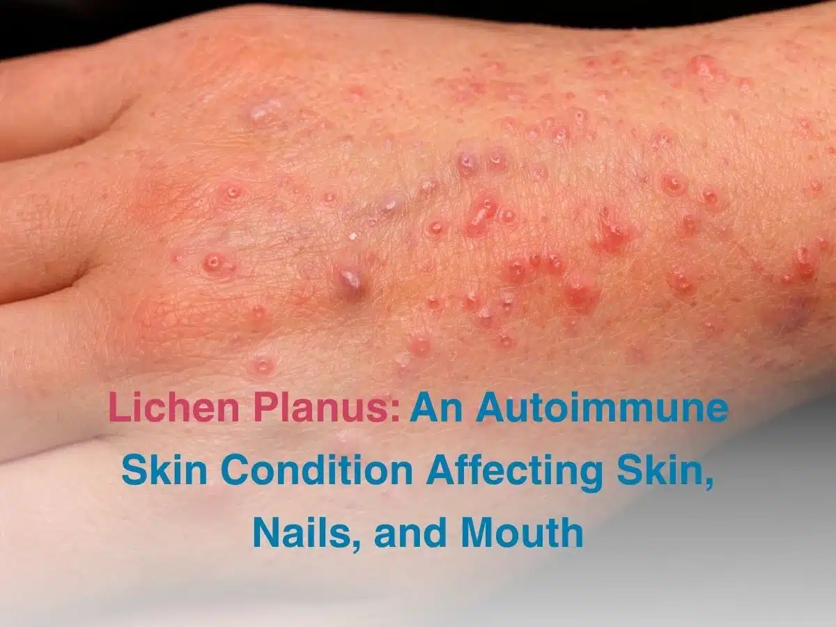 Lichen Planus_ An Autoimmune Skin Condition Affecting Skin Nails and Mouth