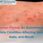 Lichen Planus_ An Autoimmune Skin Condition Affecting Skin Nails and Mouth
