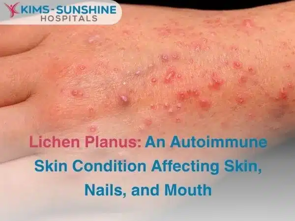 Lichen Planus_ An Autoimmune Skin Condition Affecting Skin Nails and Mouth