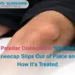 Patellar Dislocation_ Why the Kneecap Slips Out of Place and How Its Treated