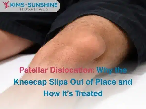 Patellar Dislocation_ Why the Kneecap Slips Out of Place and How Its Treated