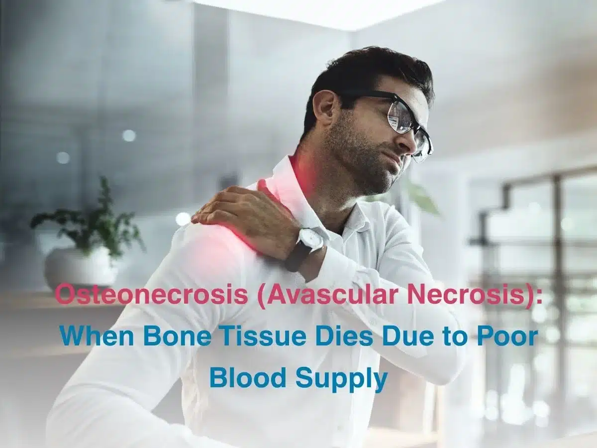 Shoulder Impingement Syndrome_ Causes of Persistent Shoulder Pain and Limited Movement - Multispeciality Hospital Osteonecrosis (Avascular Necrosis)_ When Bone Tissue Dies Due to Poor Blood Supply