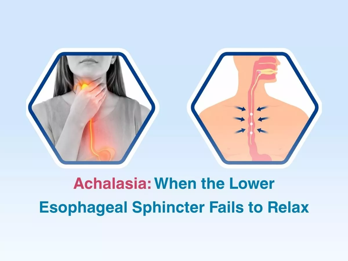 achalasia-when-the-lower-esophageal-sphincter-fails-to-relax-69ce032ac5bd6 - Multispeciality Hospital Achalasia: When the Lower Esophageal Sphincter Fails to Relax