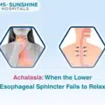Achalasia: When the Lower Esophageal Sphincter Fails to Relax