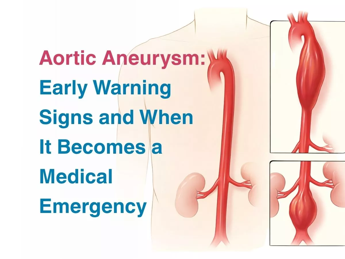 Aortic Aneurysm: Early Warning Signs and When It Becomes a Medical Emergency 