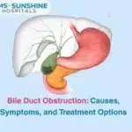Bile Duct Obstruction: Causes, Symptoms, and Treatment Options