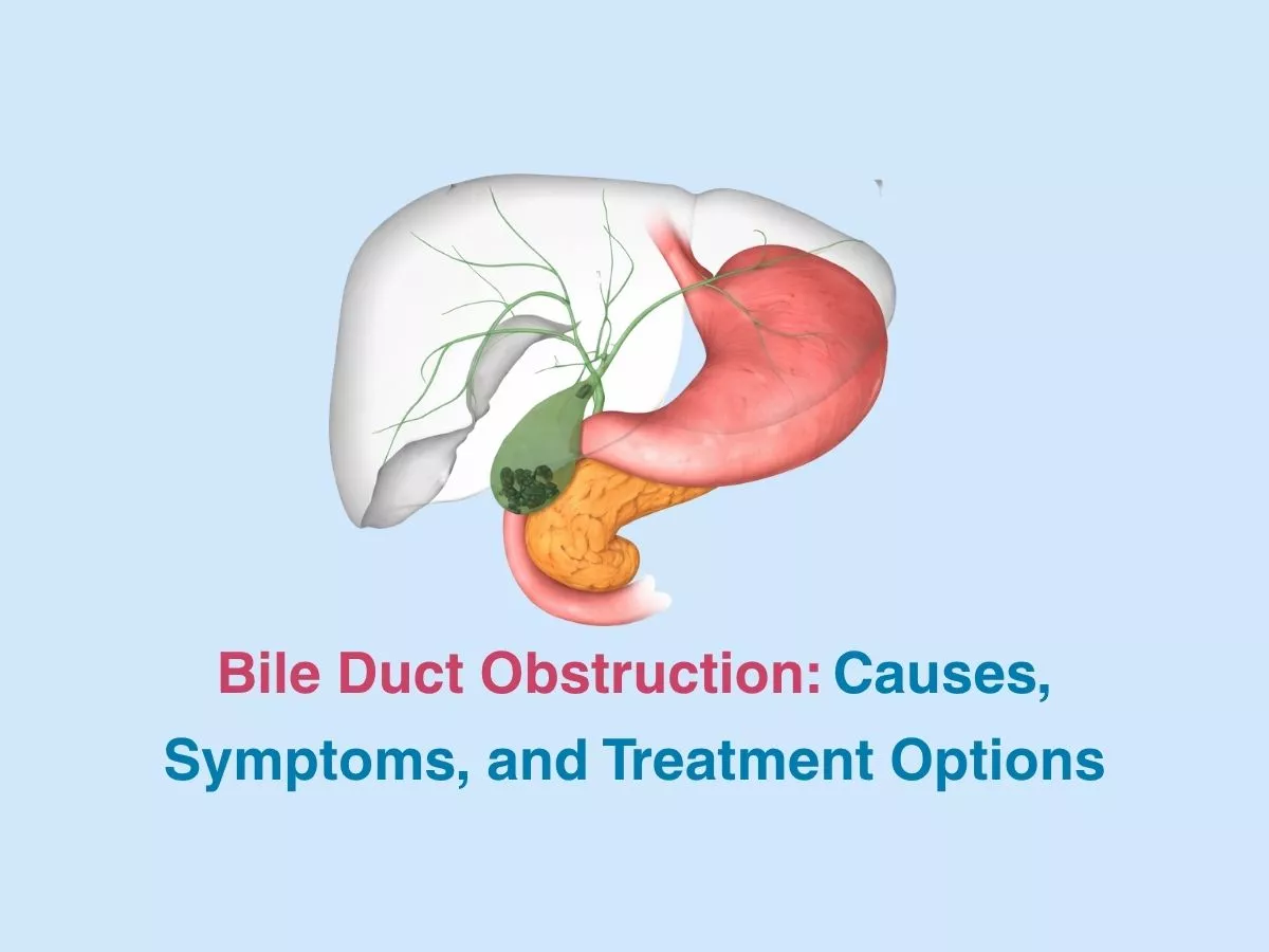 bile-duct-obstruction-causes-symptoms-and-treatment-options-69ce0637f29d7 - Multispeciality Hospital Bile Duct Obstruction: Causes, Symptoms, and Treatment Options