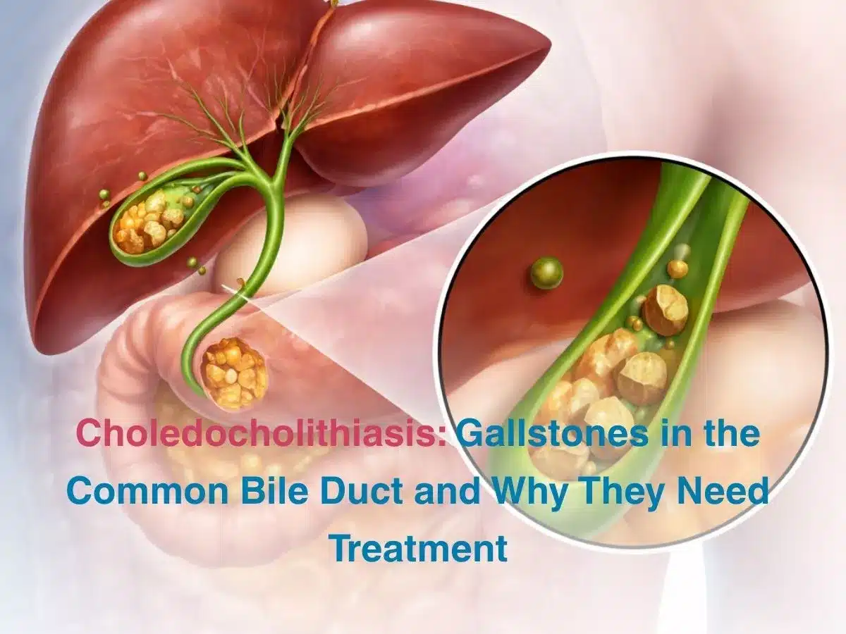 choledocholithiasis-gallstones-in-the-common-bile-duct-and-why-they-need-treatment-69cf627a20a19 - Multispeciality Hospital Choledocholithiasis: Gallstones in the Common Bile Duct and Why They Need Treatment