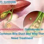 Choledocholithiasis: Gallstones in the Common Bile Duct and Why They Need Treatment