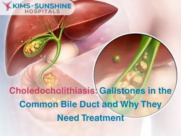 Choledocholithiasis: Gallstones in the Common Bile Duct and Why They Need Treatment