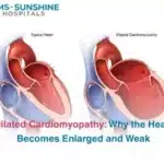 Dilated Cardiomyopathy: Why the Heart Becomes Enlarged and Weak