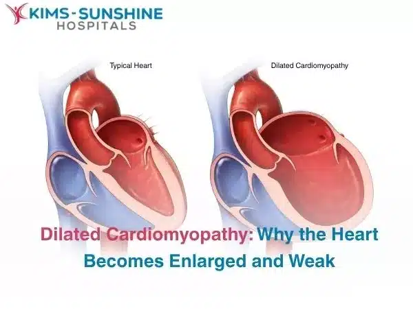 Dilated Cardiomyopathy: Why the Heart Becomes Enlarged and Weak