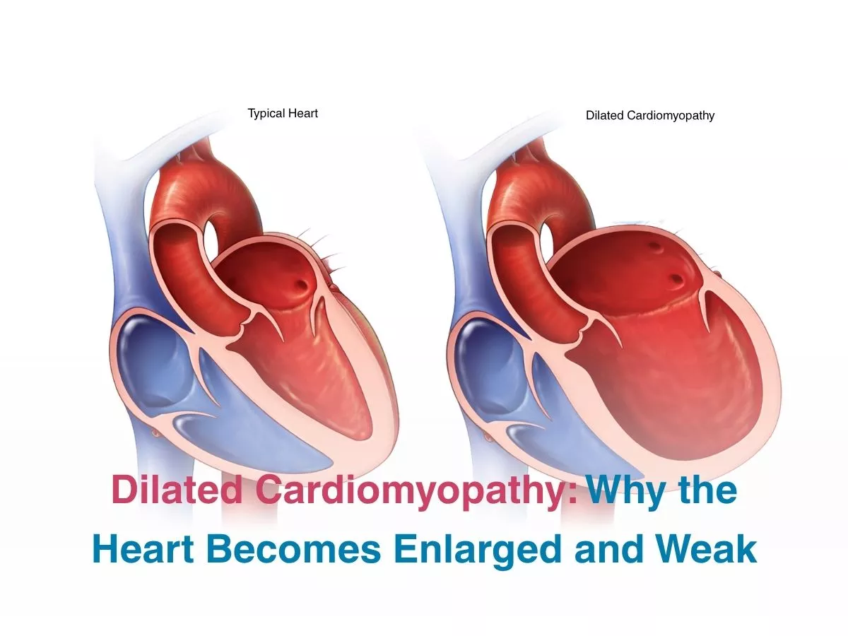 Dilated Cardiomyopathy: Why the Heart Becomes Enlarged and Weak