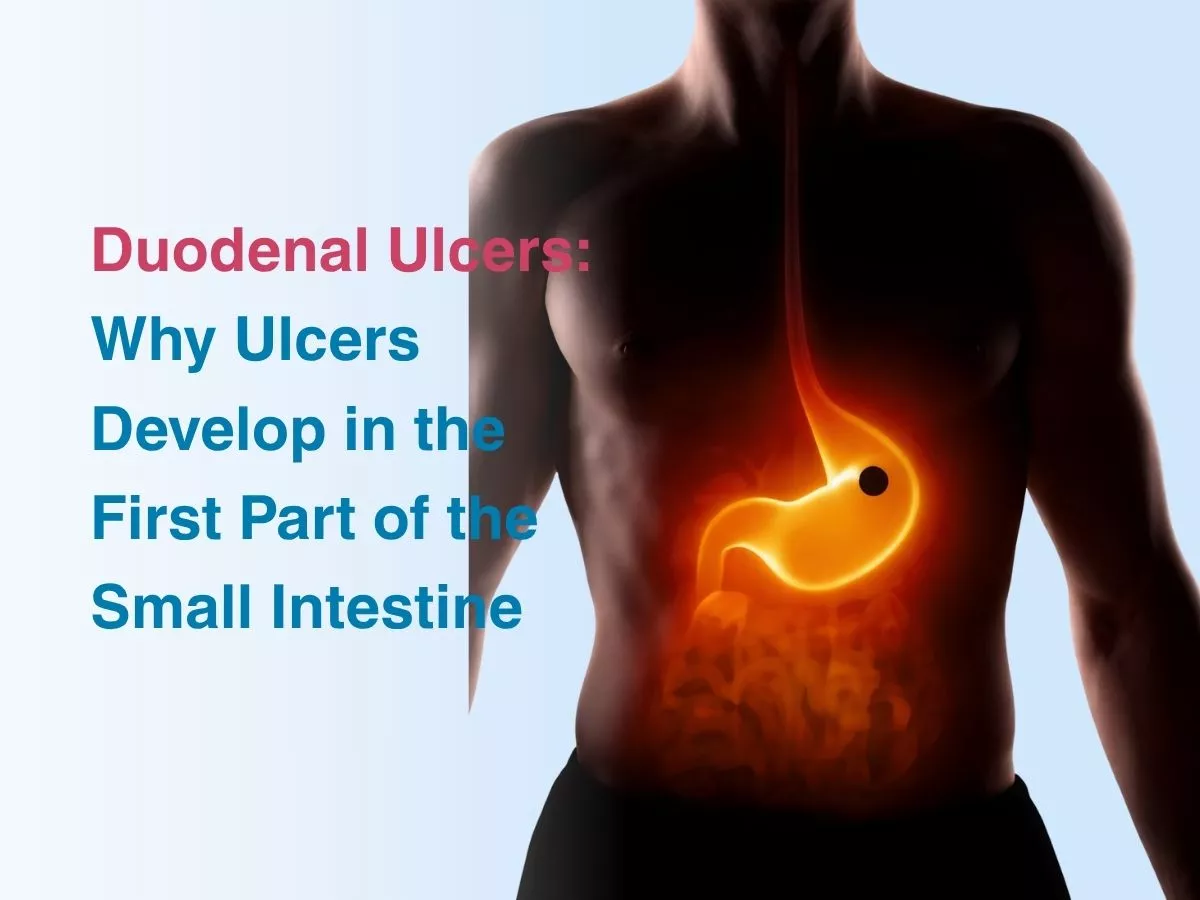 Duodenal Ulcers: Why Ulcers Develop in the First Part of the Small Intestine