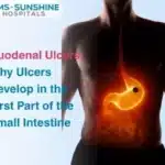 Duodenal Ulcers: Why Ulcers Develop in the First Part of the Small Intestine