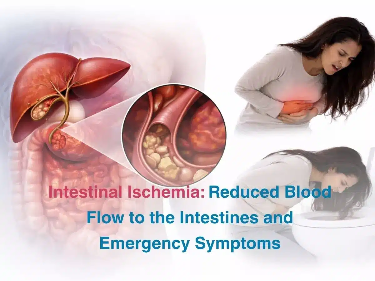 intestinal-ischemia-reduced-blood-flow-to-the-intestines-and-emergency-symptoms-69cf47fb1e01f - Multispeciality Hospital Intestinal Ischemia: Reduced Blood Flow to the Intestines and Emergency Symptoms