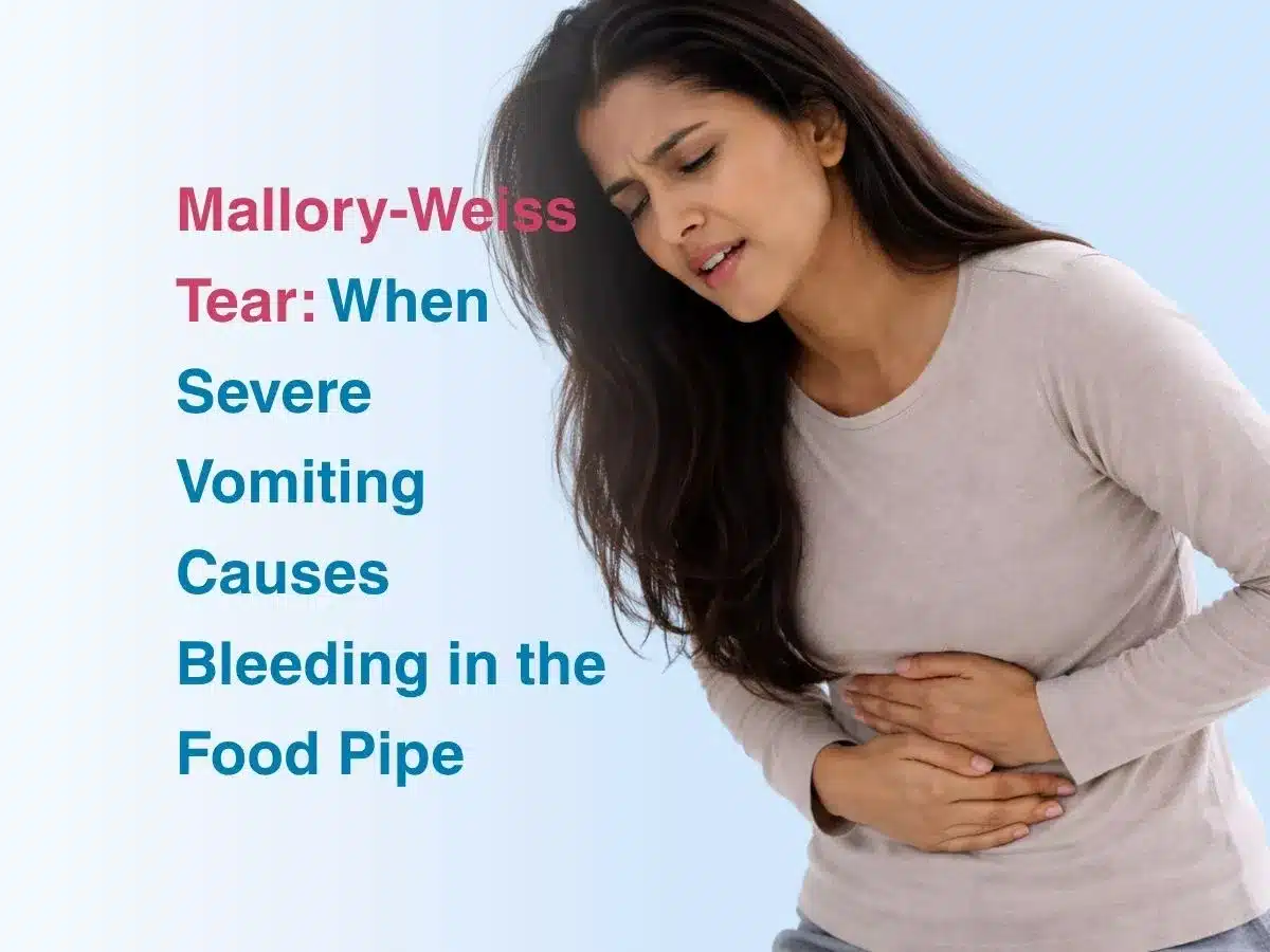 Mallory-Weiss Tear: When Severe Vomiting Causes Bleeding in the Food Pipe