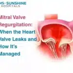 Mitral Valve Regurgitation: When the Heart Valve Leaks and How It’s Managed