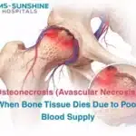 Osteonecrosis (Avascular Necrosis): When Bone Tissue Dies Due to Poor Blood Supply