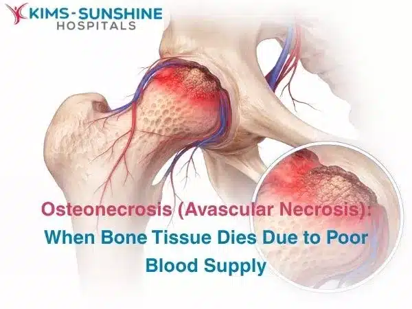 Osteonecrosis (Avascular Necrosis): When Bone Tissue Dies Due to Poor Blood Supply