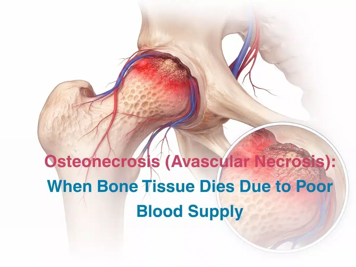 Osteonecrosis (Avascular Necrosis): When Bone Tissue Dies Due to Poor Blood Supply 