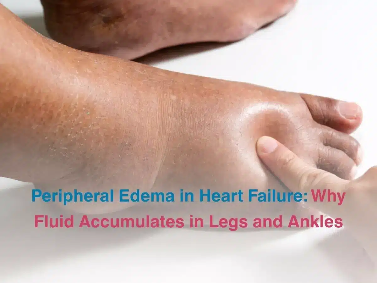 peripheral-edema-in-heart-failure-why-fluid-accumulates-in-legs-and-ankles-69ccc30a87c99 - Multispeciality Hospital Peripheral Edema in Heart Failure: Why Fluid Accumulates in Legs and Ankles