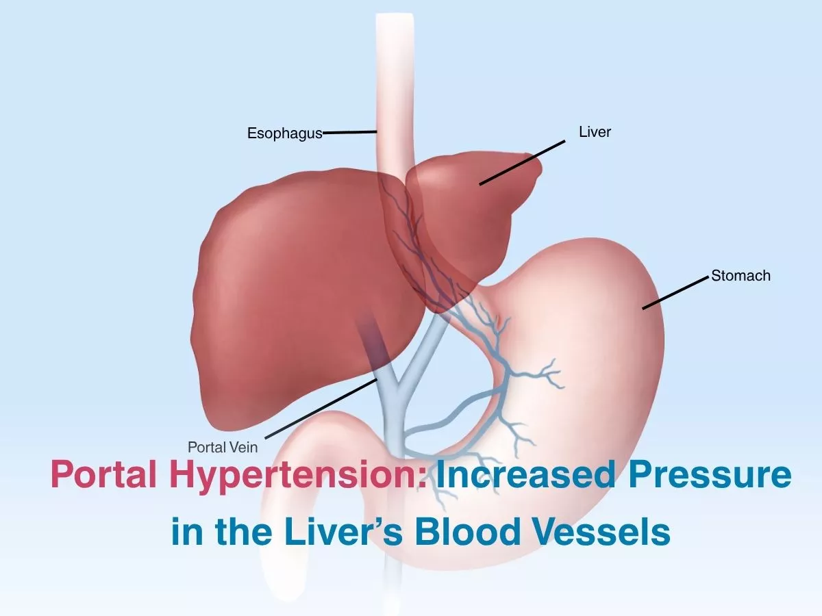 Portal Hypertension: Increased Pressure in the Liver’s Blood Vessels