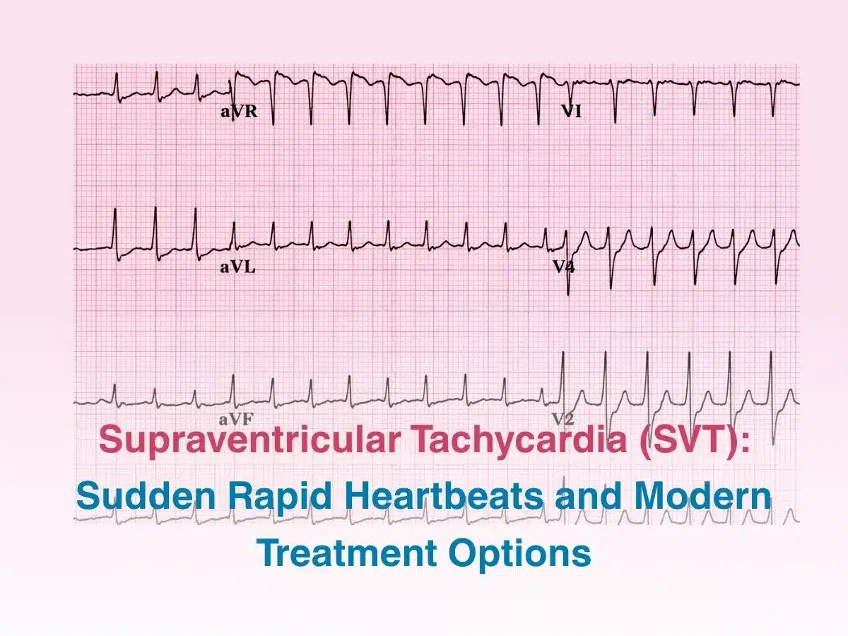 supraventricular-tachycardia-svt-sudden-rapid-heartbeats-and-modern-treatment-options-69ccbb7e3ef43 - Multispeciality Hospital Supraventricular Tachycardia (SVT): Sudden Rapid Heartbeats and Modern Treatment Options