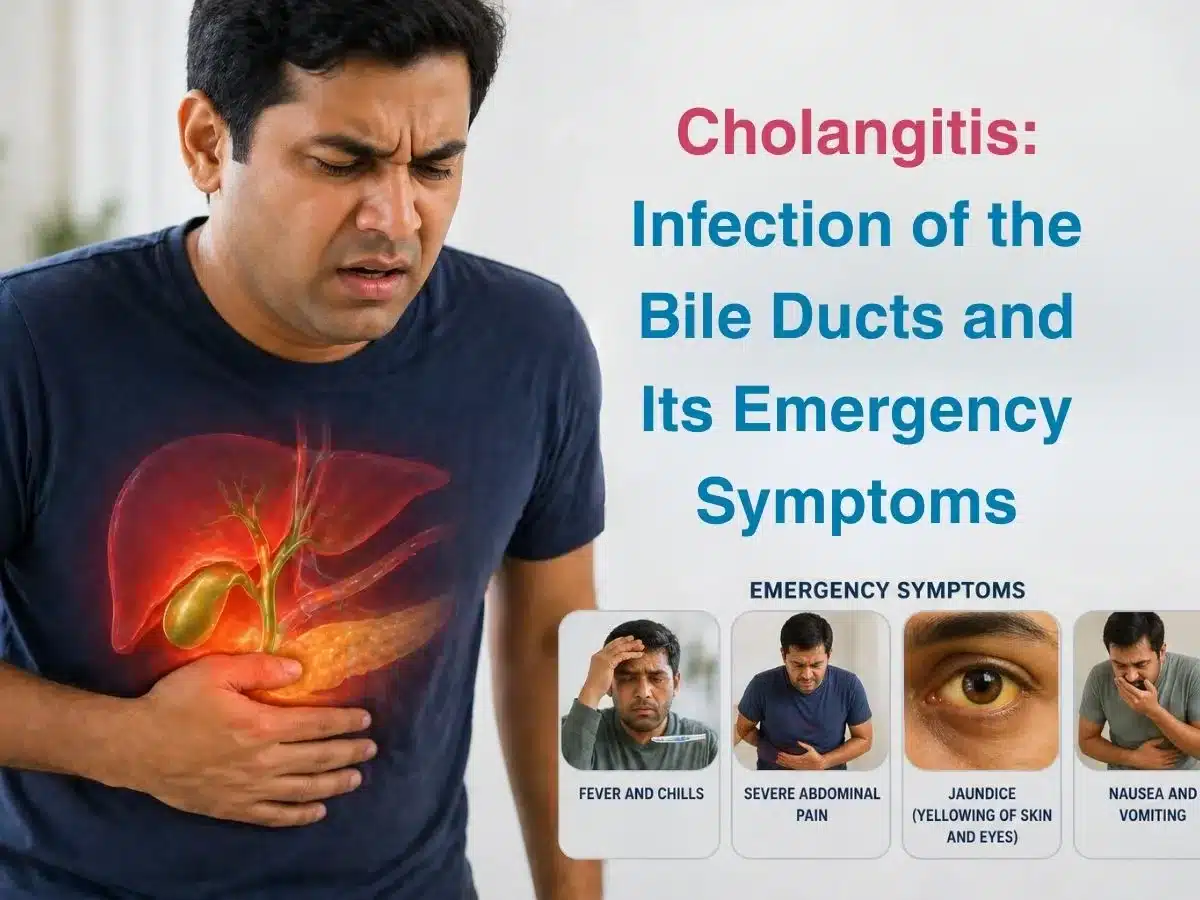 Cholangitis_ Infection of the Bile Ducts and Its Emergency Symptoms
