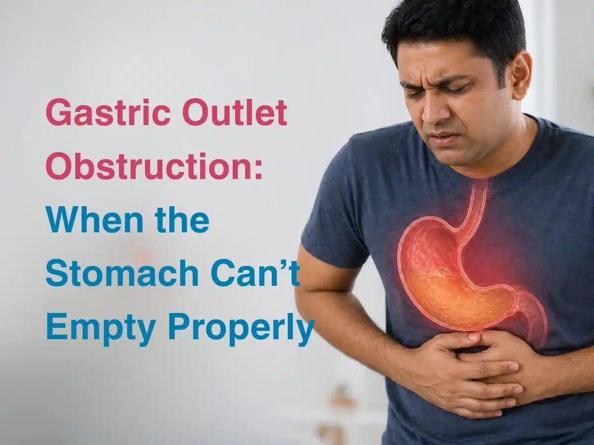 Gastric Outlet Obstruction_ When the Stomach Cant Empty Properly