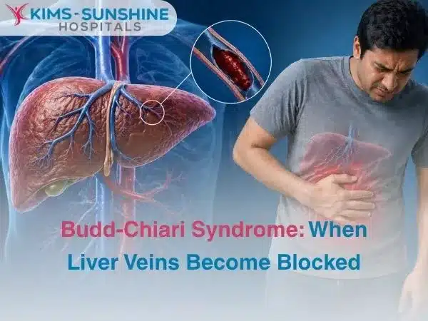 Budd-Chiari Syndrome: When Liver Veins Become Blocked