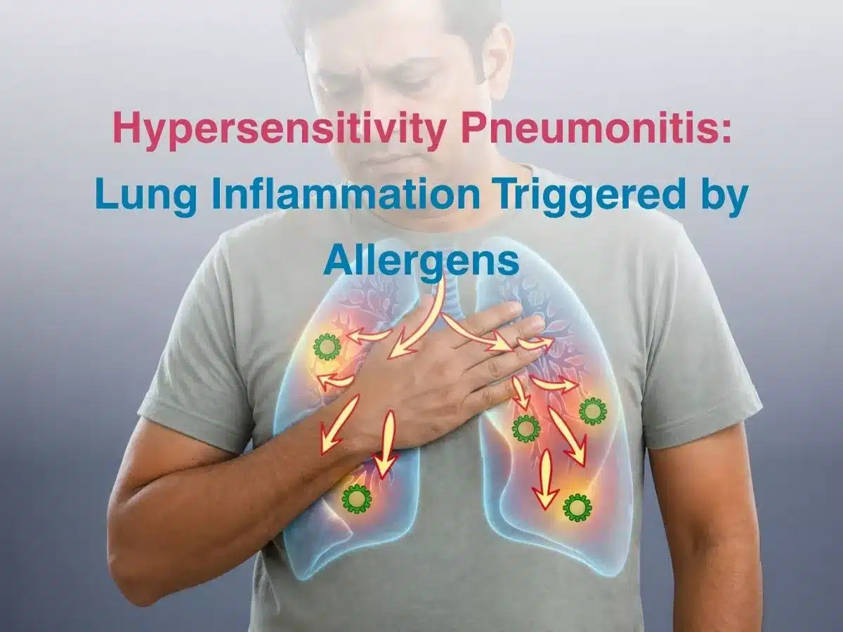 Informational graphic about hypersensitivity pneumonitis: man clutching his chest over a stylized lungs diagram with arrows and green particles, title reads 'Hypersensitivity Pneumonitis: Lung Inflammation Triggered by Allergens'.