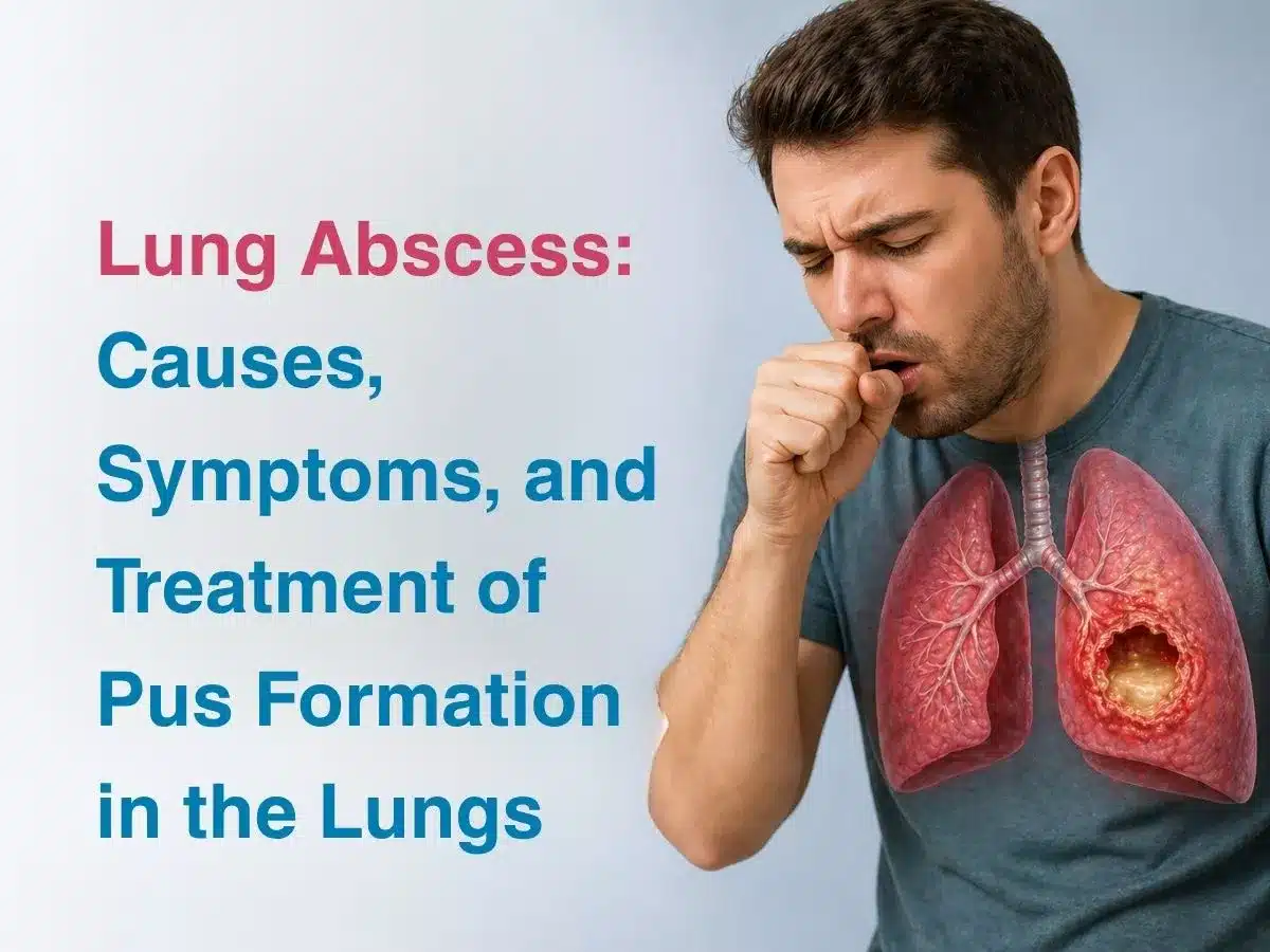 Informational image about a lung abscess: text on the left, a man coughing, and a 3D lung diagram showing a cavity.