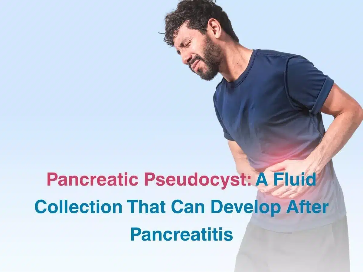 Pancreatic Pseudocyst: A Fluid Collection That Can Develop After Pancreatitis