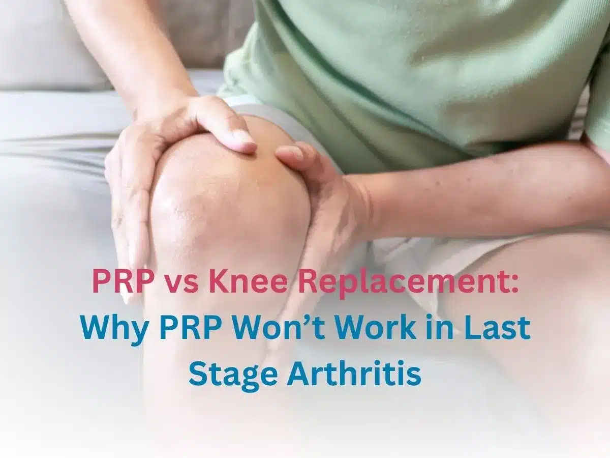prp-vs-knee-replacement-why-prp-wont-work-in-last-stage-arthritis-inside-image-6a0ed333dc642 - Multispeciality Hospital PRP vs Knee Replacement: Why PRP Won’t Work in Last Stage Arthritis