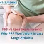 PRP vs Knee Replacement: Why PRP Won’t Work in Last Stage Arthritis