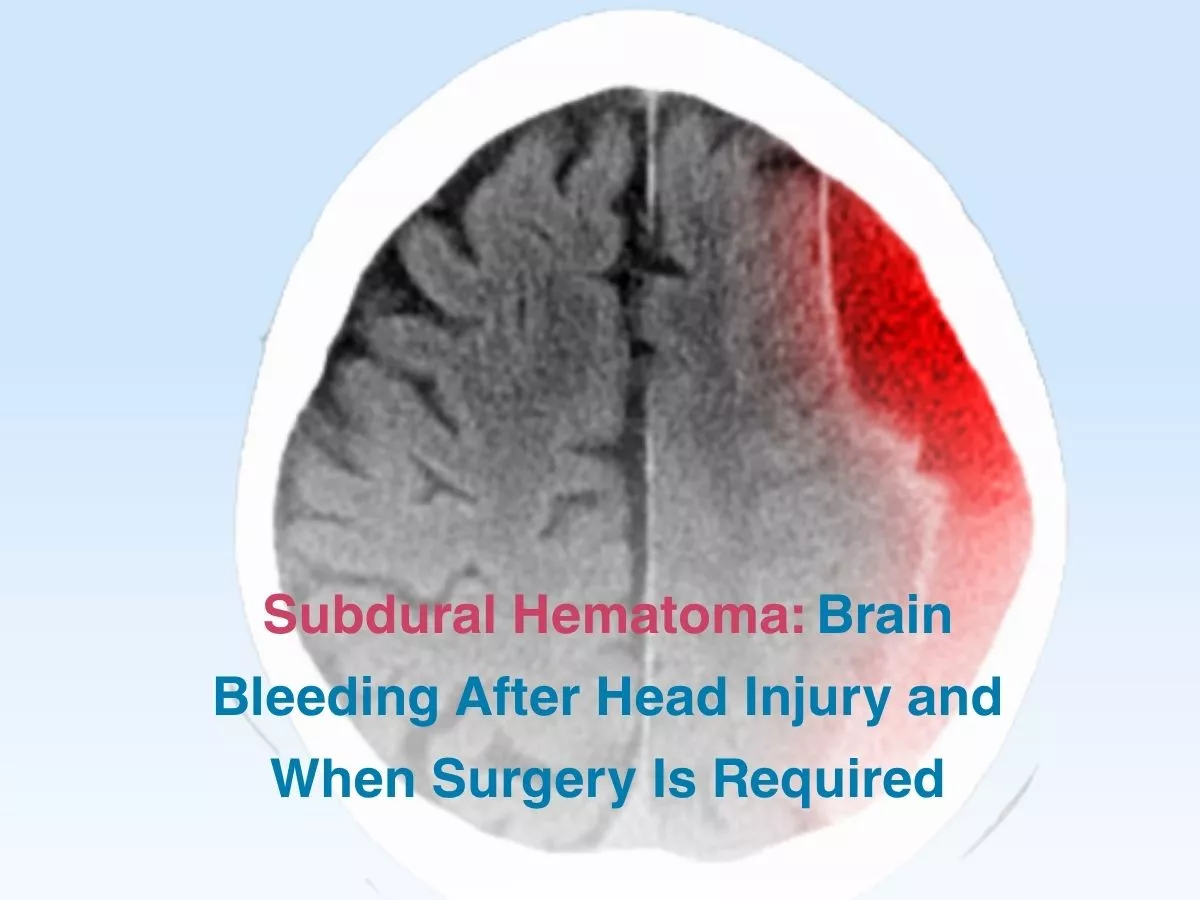 Subdural Hematoma: Brain Bleeding After Head Injury and When Surgery Is Required