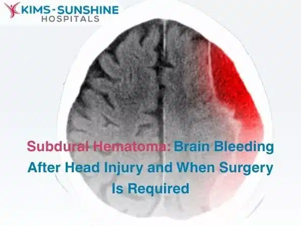 Subdural Hematoma: Brain Bleeding After Head Injury and When Surgery Is Required