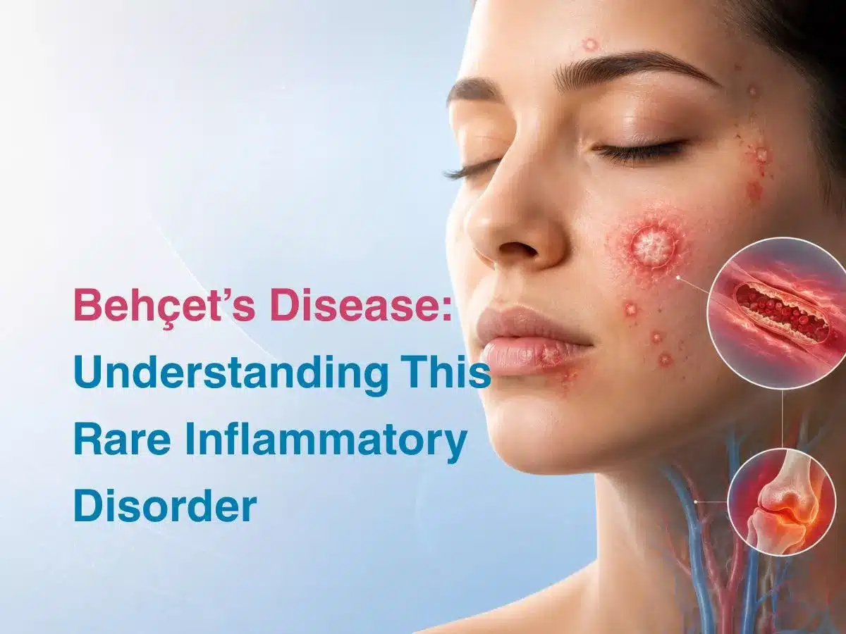 Educational graphic about Behçets Disease showing facial skin lesions and inflammatory diagrams with the title text