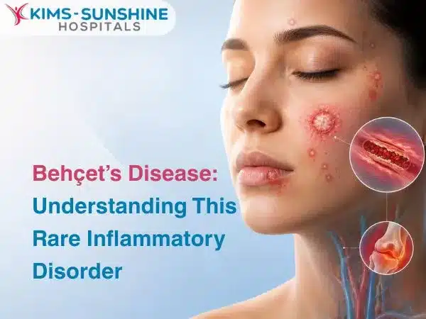 Behçets Disease Understanding This Rare Inflammatory Disorder